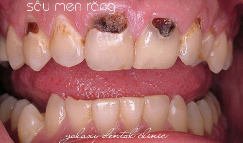 https://bacsynhakhoa.vn/img/galaxy-dental-sau-men-rang.jpg