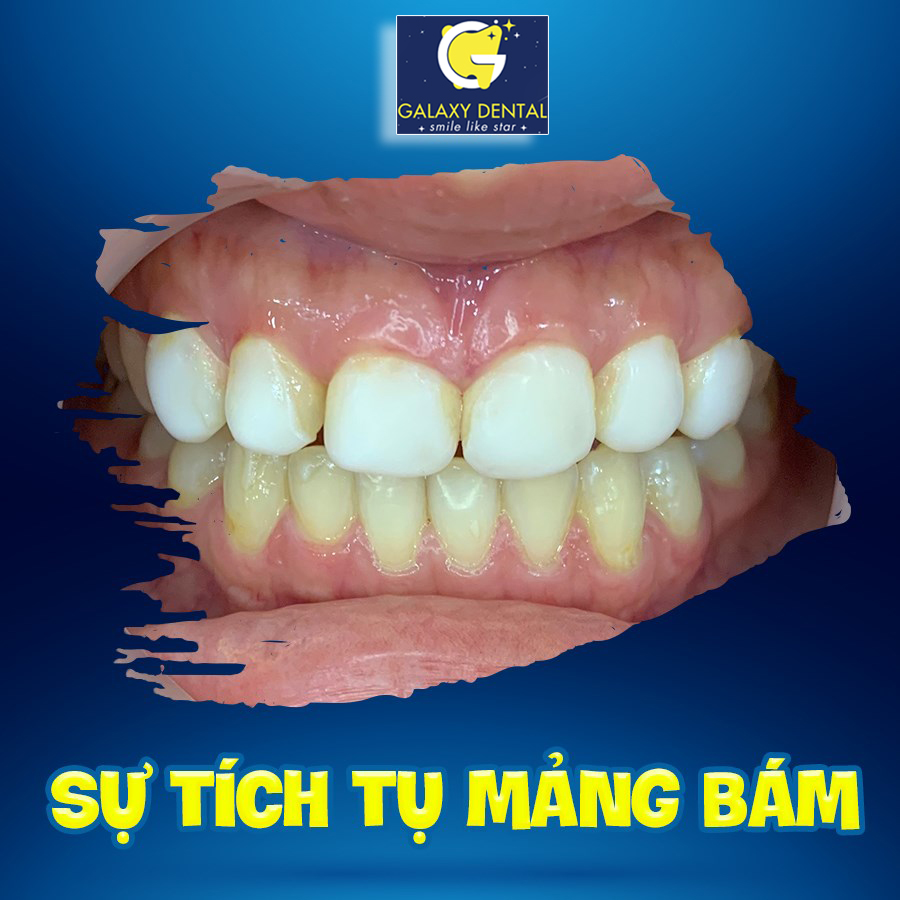 https://bacsynhakhoa.vn/img/galaxy-dental-su-tich-tu-mang-bam.jpg