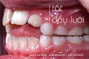 https://bacsynhakhoa.vn/img/galaxy-dental-tat-day-luoi-o-tre.jpg