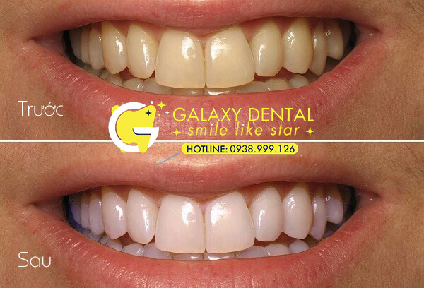 https://bacsynhakhoa.vn/img/galaxy-dental-tay-trang-rang-tai-phong-nha-gia-bao-nhieu-tien.jpg