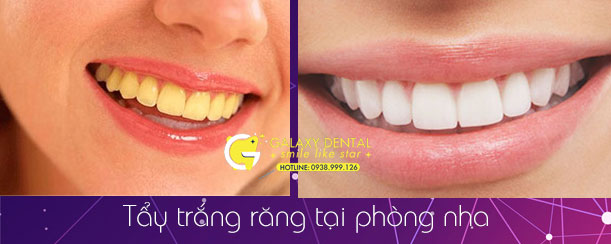 https://bacsynhakhoa.vn/img/galaxy-dental-tay-trang-rang-tai-phong-nha-truoc-va-sau-khi-tay.jpg