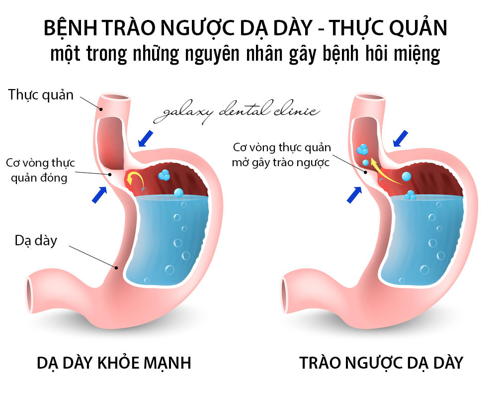 https://bacsynhakhoa.vn/img/galaxy-dental-trao-nguoc-da-day-thuc-quan-mot-trong-nhung-nguyen-nhan-gay-hoi-mieng.jpg