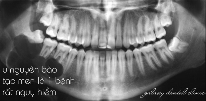 https://bacsynhakhoa.vn/img/galaxy-dental-u-nguyen-bao-tao-men-la-benh-nguy-hiem.jpg