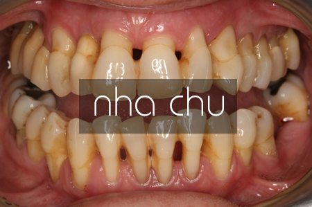 https://bacsynhakhoa.vn/img/galaxy-dental-viem-nha-chu-gay-rung-rang.png