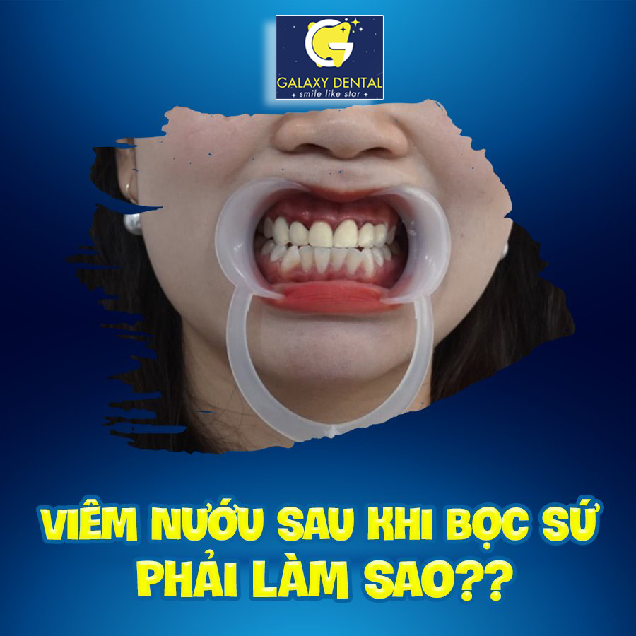 https://bacsynhakhoa.vn/img/galaxy-dental-viem-nuou-sau-khi-boc-rang-su.jpg