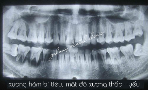 https://bacsynhakhoa.vn/img/galaxy-dental-xuong-ham-tieu-mat-do-xuong-thap-yeu.jpg