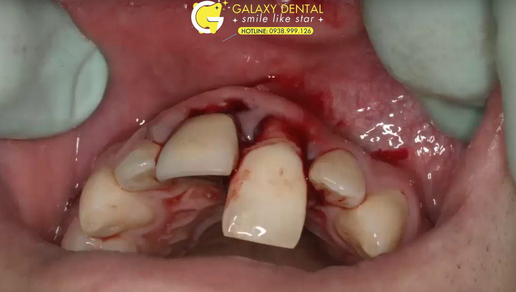 https://bacsynhakhoa.vn/img/galaxydental-rang-roi-ra-ngoai.jpg