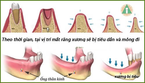 https://bacsynhakhoa.vn/img/nha-khoa-ngan-ha-tieu-xuong-o-rang-do-mat-rang.jpg