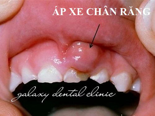 https://bacsynhakhoa.vn/uploads/galaxy-dental-ap-xe-nuou-do-sau-rang-02.jpg
