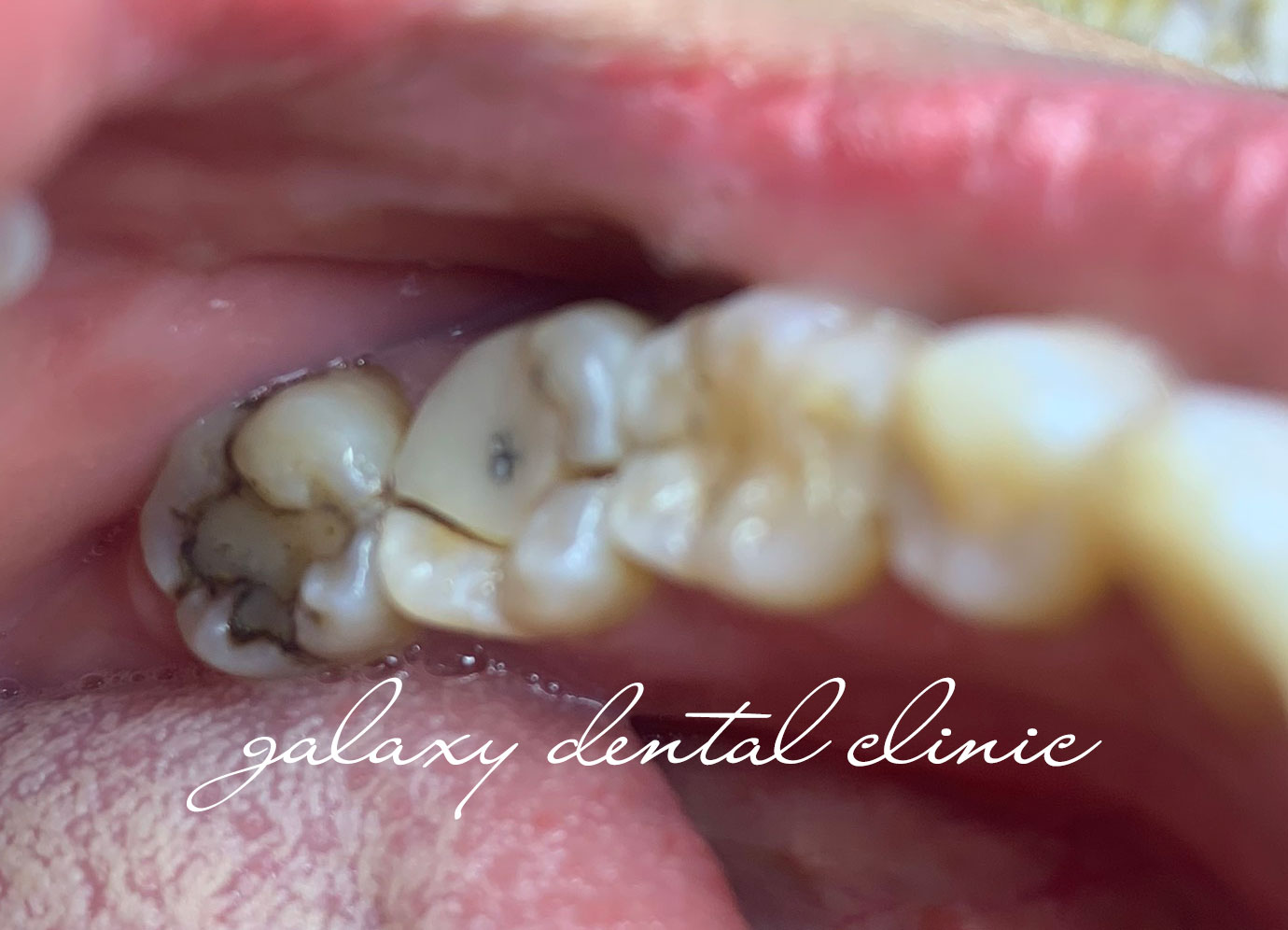 Nếu răng lấy tủy bị vỡ, liệu có thể phục hồi răng bằng phương pháp thẩm mỹ?
