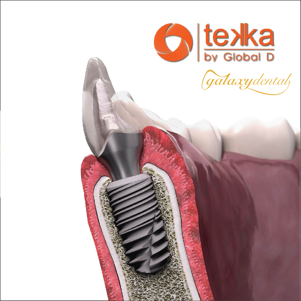 https://bacsynhakhoa.vn/uploads/galaxy-dental-implant-teka.png