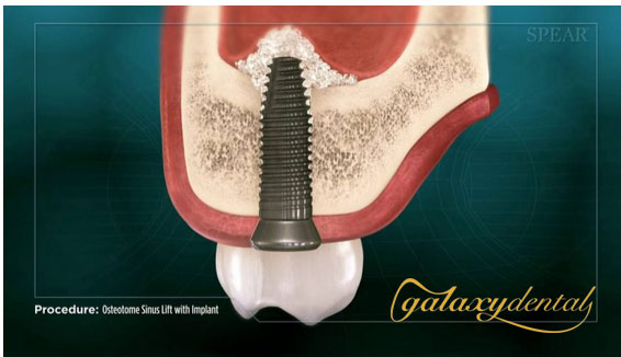 https://bacsynhakhoa.vn/uploads/galaxy-dental-ky-thuat-nang-xoang-trong-cay-ghep-implant-nha-khoa.jpg