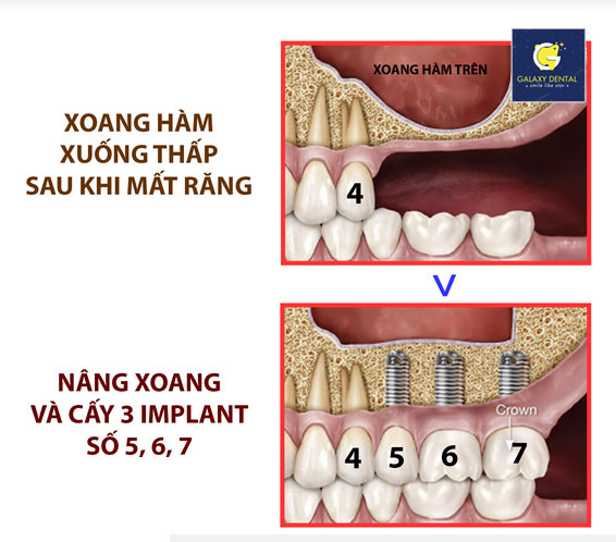 https://bacsynhakhoa.vn/uploads/galaxy-dental-ky-thuat-nang-xoang-trong-cay-ghep-implant.jpg