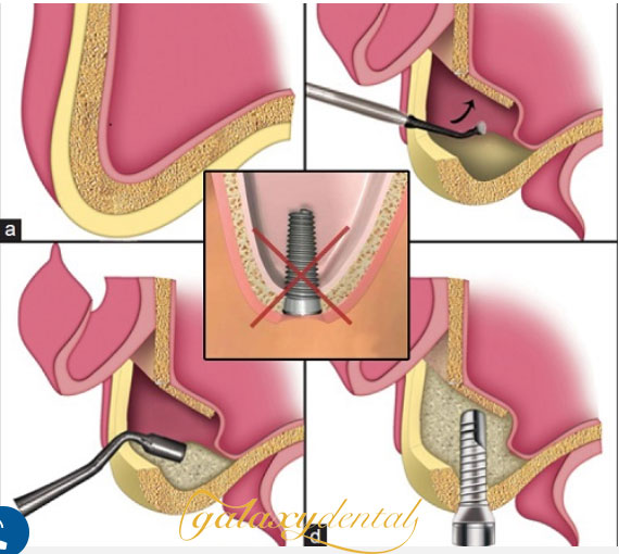 https://bacsynhakhoa.vn/uploads/galaxy-dental-ky-thuat-nang-xoanh-ho-trong-cay-ghep-implant-nha-khoa.jpg