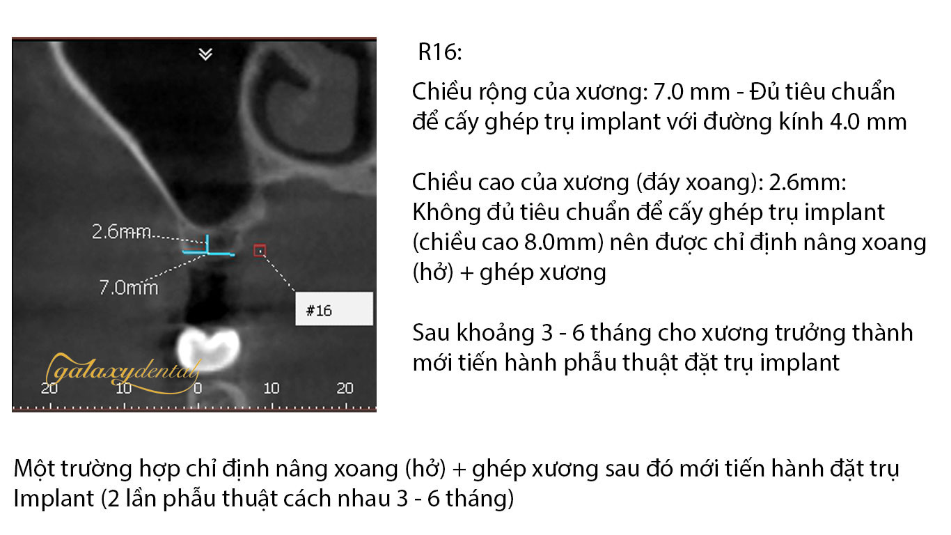 https://bacsynhakhoa.vn/uploads/galaxy-dental-nang-xoang-ho-ghep-xuong-trong-cay-ghep-implant-nha-khoa.jpg