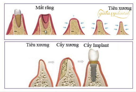 https://bacsynhakhoa.vn/uploads/galaxy-dental-qua-trinh-tieu-xuong-va-cay-ghep-implant.jpg