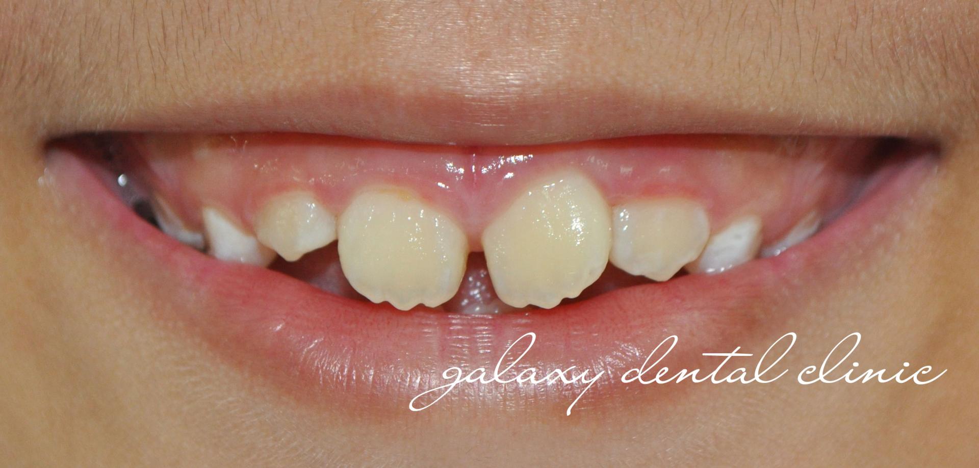 https://bacsynhakhoa.vn/uploads/galaxy-dental-rang-vinh-vien-cua-tre-khi-moi-duoc-thay-the-se-co-mau-vang.jpg