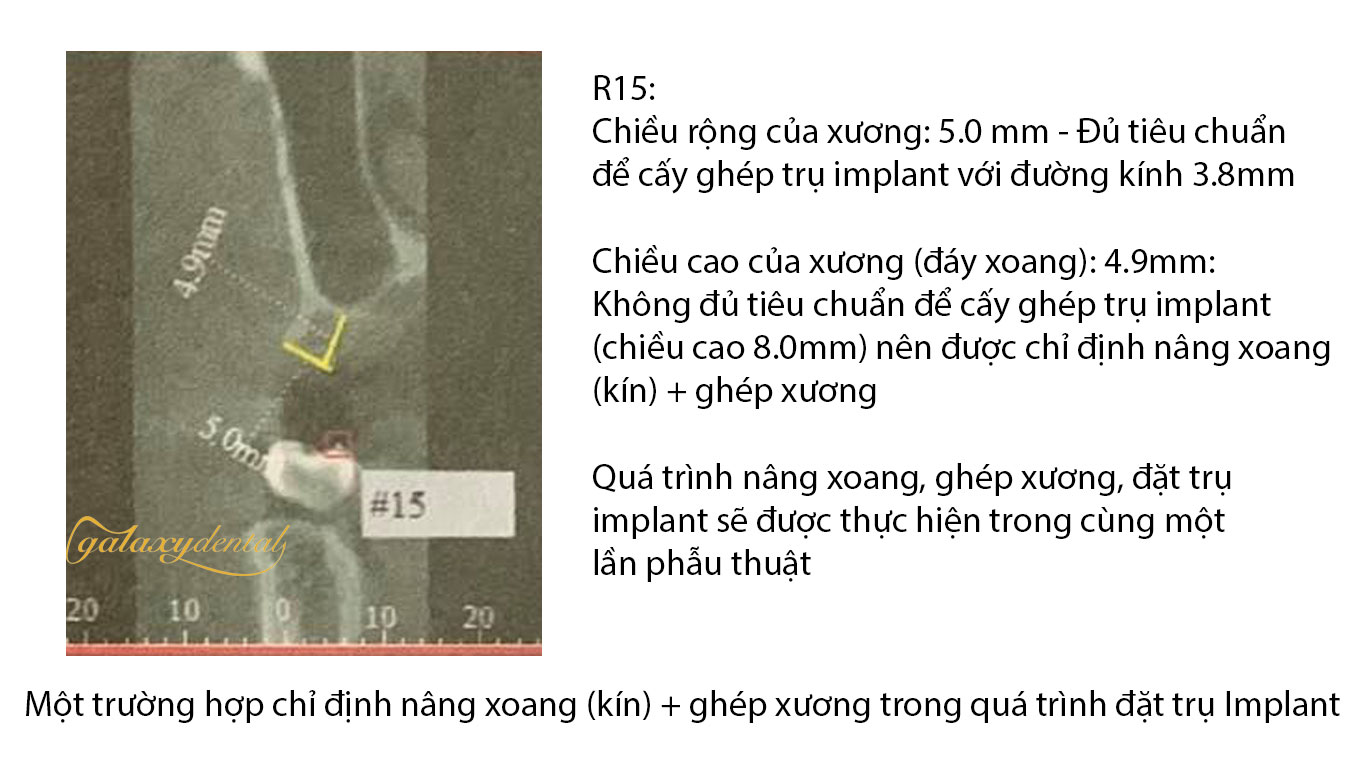 https://bacsynhakhoa.vn/uploads/galaxy-dental-truong-hop-nang-xoang-ghep-xuong-cay-trong-cay-ghep-implant-nha-khoa.jpg