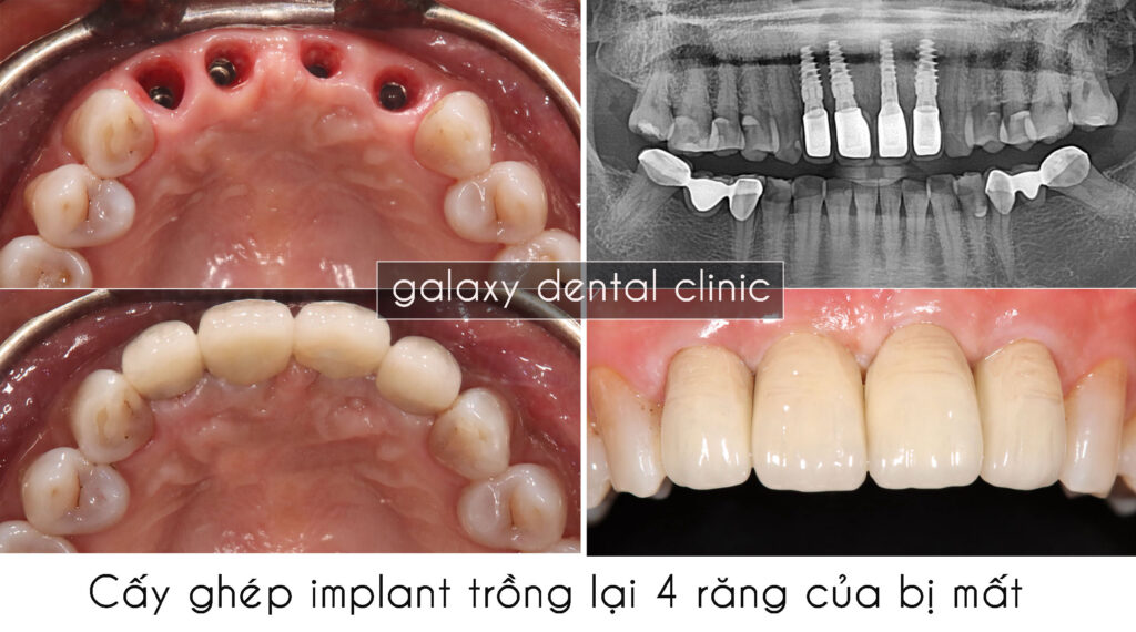 galaxy-dental-clinic-cay-ghep-implant-trong-lai-4-rang-cua-bi-mat-bs-mung